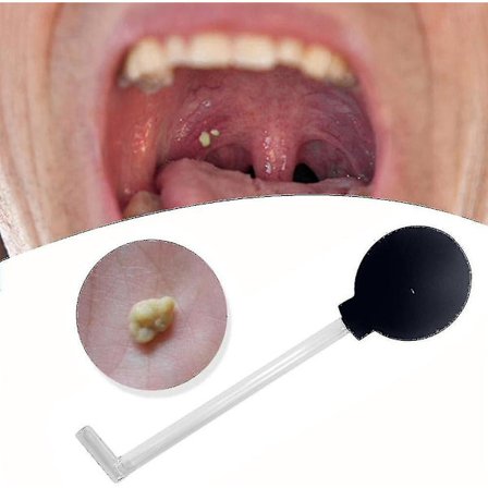 Tonsilstenfjerner Vakuum, Tonsilstenfjernelseskit Værktøj Tonsilstenbehandling Oral Sugningsværktøj, Tandsugende Mundrenser Mundrensning Oral