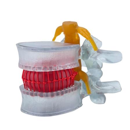 Lannelevyn herniaatiomalli liikkuva lannerangan malli patologisen lannelevyn lannenikaman osoittamiseen