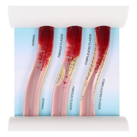 Manikin krop plastik LDL model plastik undervisningsmodel dynamisk LDL model blodkar anatomi model arterie vene model
