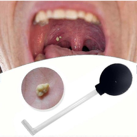 Tonsillsten Borttagare Vakuum, Tonsillsten Borttagningskit Verktyg Tonsillsten Sugverktyg, Dental Sug Munrengöring