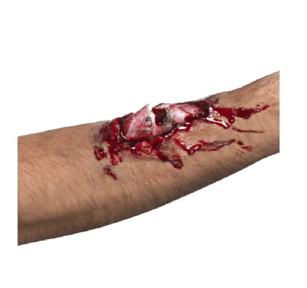 Brutet ben i köttigt sår