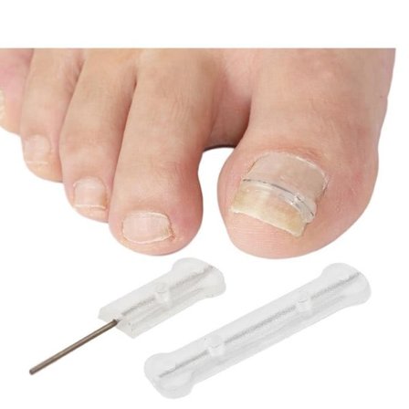 10 stk. æske indgroet tånegl korrektion værktøj indgroet tå negl behandling elastik plaster klistermærke opretning clips