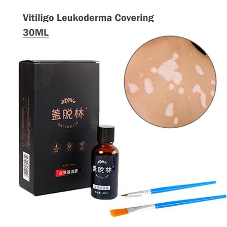 30 ml Vitiligo Leukoderma Dækkende Væske Vandfast Concealer Flydende Creme Ansigtsfarvet Hud Vitiligo Pletter Makeup
