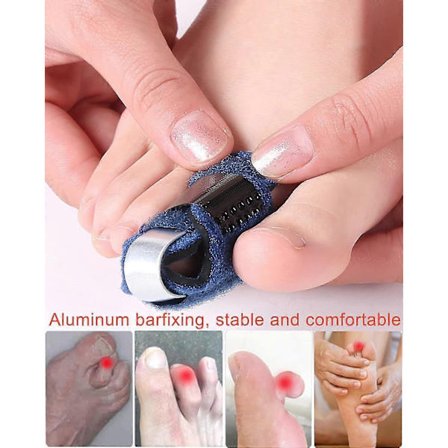 Venstre Tårettetang, Pustende Hammer Tåskinne Brudd Klo Tåfiksering Korrigeringsstropp Tårettetang