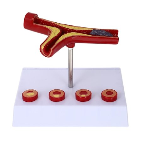 Aterosklerose Medisinsk Modell Blodkar Anatomisk Modell Kardiovaskulær Modell