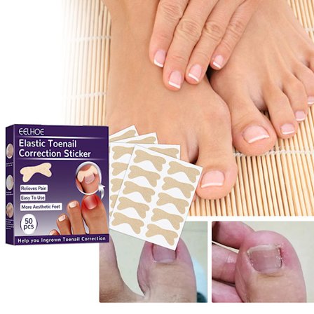 50 kpl sisäänkasvaneiden varpaiden kynsien korjaustarra Nail Strip Corrector St